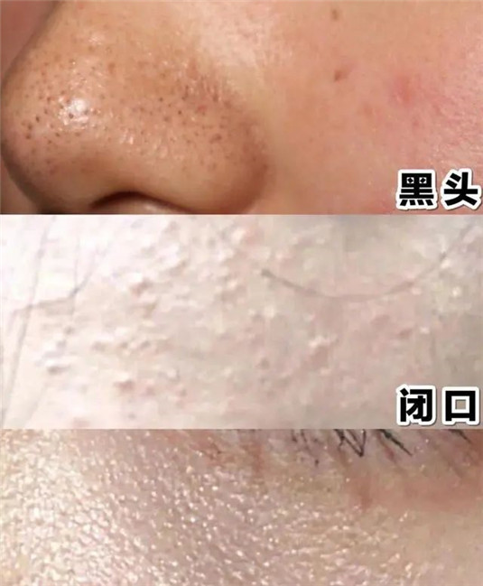 春季护肤小诀窍，告别长痘、起皮、过敏，做冻龄般的女人  皮肤 肌肤 春季 第1张