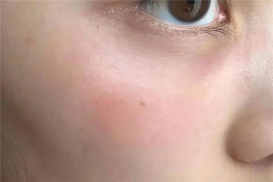春季护肤小诀窍，告别长痘、起皮、过敏，做冻龄般的女人  皮肤 肌肤 春季 第4张