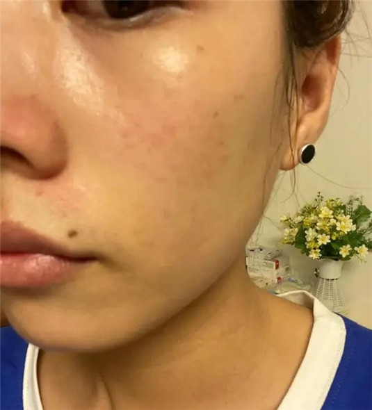 春季护肤小诀窍，告别长痘、起皮、过敏，做冻龄般的女人  皮肤 肌肤 春季 第5张
