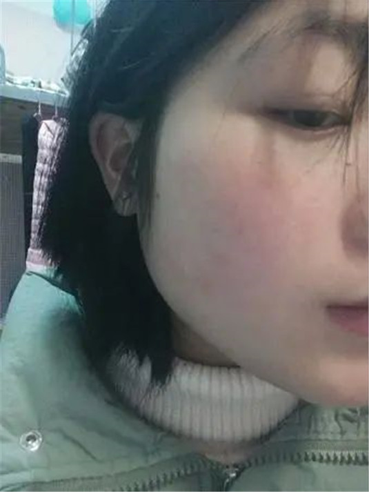 干货，怎样刷酸才能正确祛痘控油、去黑头、闭口，最强刷酸攻略  皮肤 水杨酸 闭口 第8张