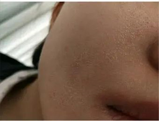 干货，怎样刷酸才能正确祛痘控油、去黑头、闭口，最强刷酸攻略  皮肤 水杨酸 闭口 第14张