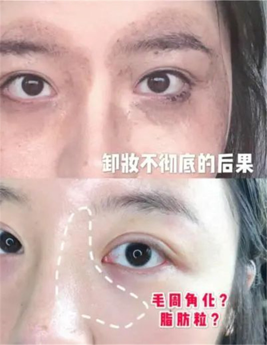 闷逗、长闭口那是你的卸妆油用错了，油敏肌的卸妆挚爱好物  卸妆 妹子 卸妆油 第3张