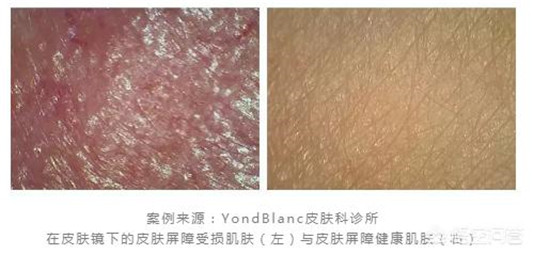 每天坚持敷面膜五年后会有什么变化,结果可能并不美好 百科 有什么 五年 后会 第4张 每天坚持敷面膜五年后会有什么变化,结果可能并不美好 百科 有什么 五年 后会 第4张