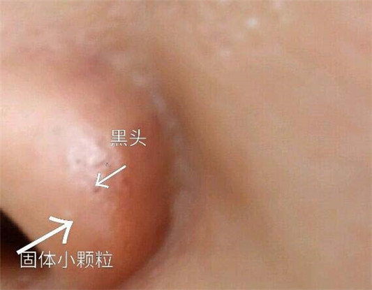 维e能揉出黑头吗,实测用维e擦脸半年后的去黑头效果 百科 实测 黑头 擦脸 第3张 维e能揉出黑头吗,实测用维e擦脸半年后的去黑头效果 百科 实测 黑头 擦脸 第3张
