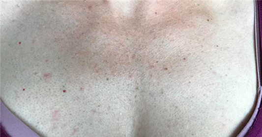 胸口长痘痘总是不消怎么办,3大原因及治疗方法一次告诉你! 百科 告诉你 治疗方法 胸口 第3张 胸口长痘痘总是不消怎么办,3大原因及治疗方法一次告诉你! 百科 告诉你 治疗方法 胸口 第3张