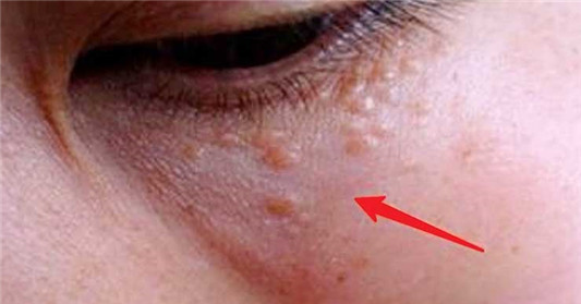 脂肪粒是什么，为什么会产生呢，该如何去除呢，