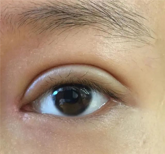 割双眼皮时，要不要“开眼角”？听过来人说的这几点，就知道了！  眼角 第2张