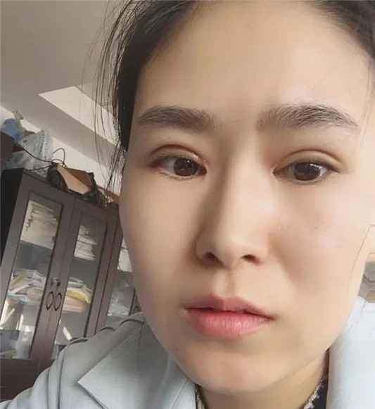 割双眼皮时，要不要“开眼角”？听过来人说的这几点，就知道了！  眼角 第10张