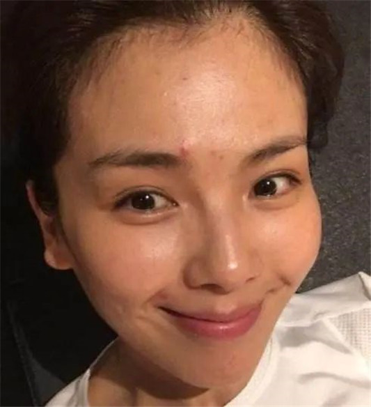 皮肤易出油爱长痘怎么办？做好这几点，皮肤会慢慢变好起来！