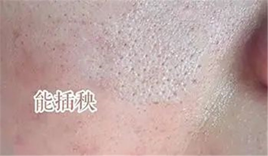 毛孔粗大、黑头、闭口咋办？3招细成蛋白肌