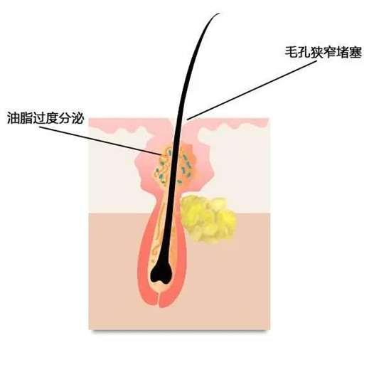 毛孔粗大、黑头、闭口咋办？3招细成蛋白肌  毛孔 第2张