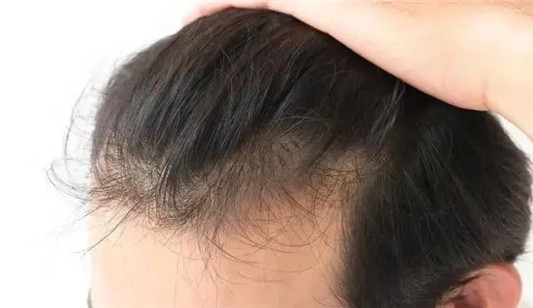 早被列入黑名单的洗发水，导致脱发严重，你知道了吗  洗发水 第4张