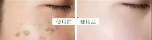 东星祛斑霜效果怎么样，东星祛斑霜使用多久才有效果  祛斑 东星祛斑霜效果怎么样 东星祛斑霜使用多久才有效果 第11张