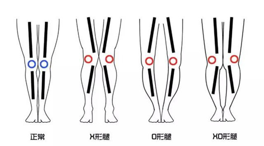 怎么判断O型腿和X型腿，达人告诉你原因及矫正方式！  百科 告诉你 矫正 达人 第2张