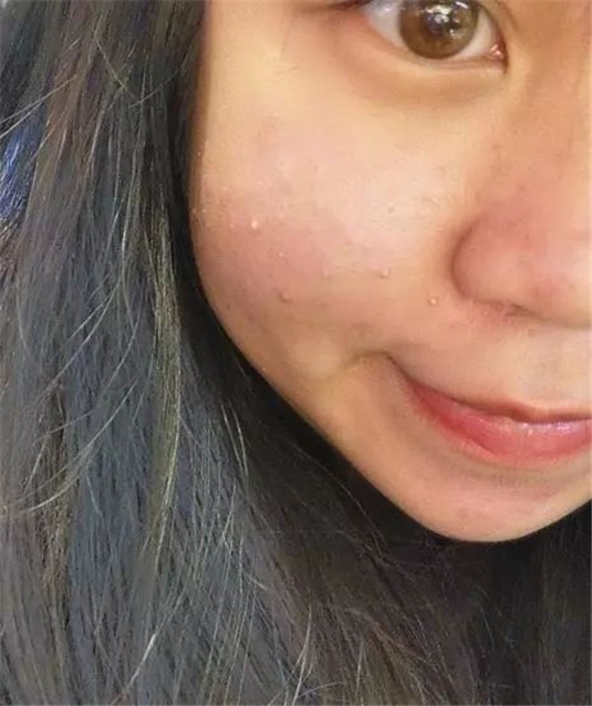 脸上出现这「四种情况」最影响颜值，长斑很显老长痘痘最丑  四种 痘痘 第2张