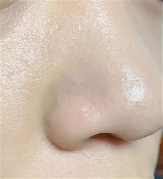 脸上出现这「四种情况」最影响颜值，长斑很显老长痘痘最丑  四种 痘痘 第9张