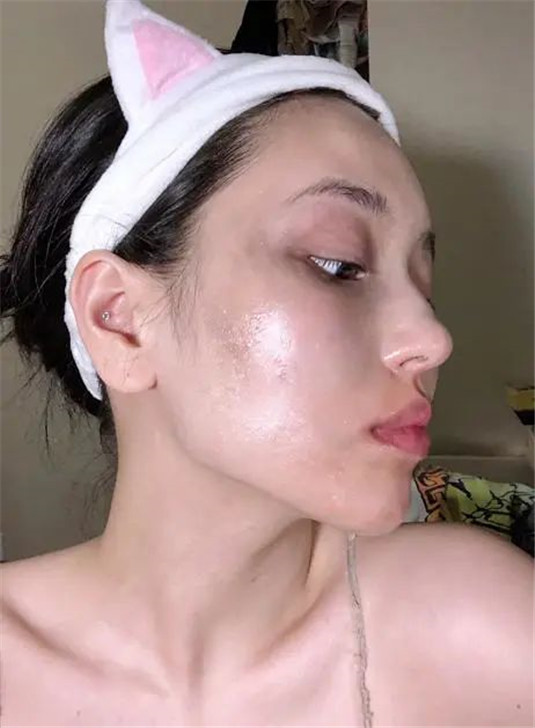 别再用手挤黑头了，容易发炎还会留坑，这3个方法才真正有效  黑头 皮肤 方法 第4张