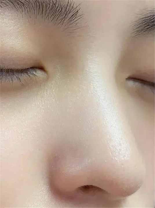别再用手挤黑头了，容易发炎还会留坑，这3个方法才真正有效  黑头 皮肤 方法 第9张