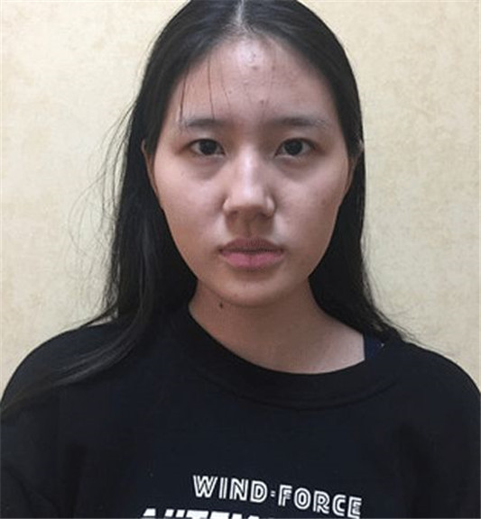 记录女生隆鼻术后88天的变化，过程虽痛苦，但结果很美丽