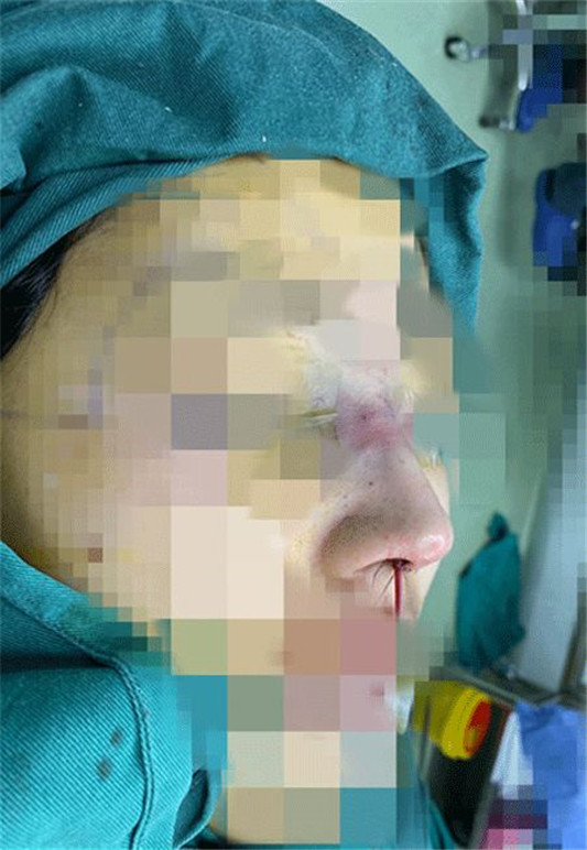 记录女生隆鼻术后88天的变化，过程虽痛苦，但结果很美丽  鼻子 术后 医生 第2张