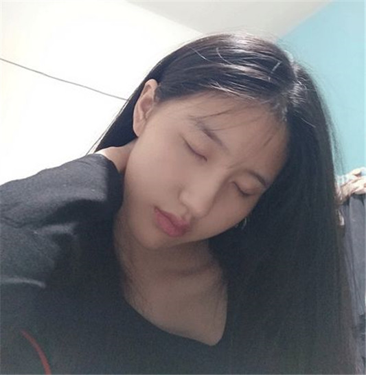 记录女生隆鼻术后88天的变化，过程虽痛苦，但结果很美丽  鼻子 术后 医生 第4张