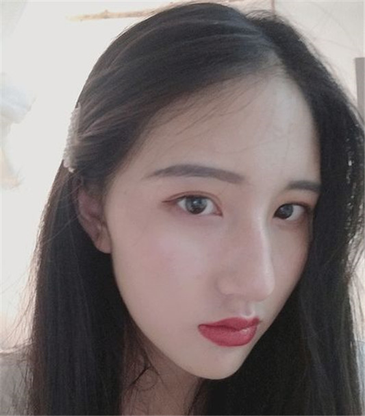 记录女生隆鼻术后88天的变化，过程虽痛苦，但结果很美丽  鼻子 术后 医生 第6张