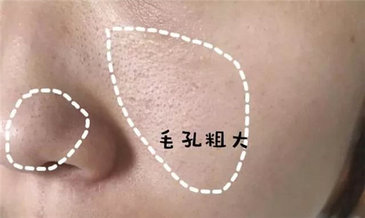 自己到底是什么肤质这篇文章统统告诉你  肌肤 干性 肤质 第10张