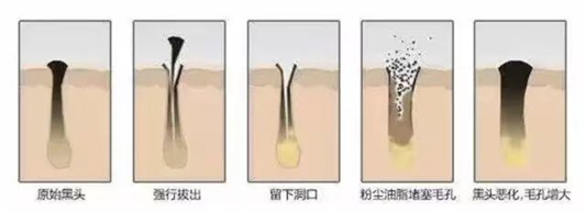 黑头除不尽，一茬接着一茬来揭秘黑头下方小秘密，去黑头小妙招  黑头 毛孔 油脂 第5张