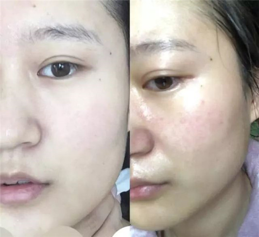 敏感肌应该怎样正确调理护肤这篇干货满满的文章一定不能错过