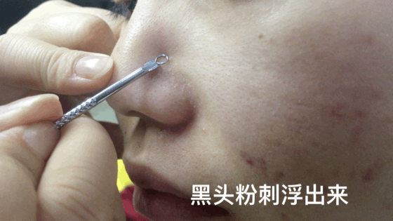 一口气挤出所有陈年黑头，实在是太太太太爽了  毛孔 肌肤 清洁 第9张
