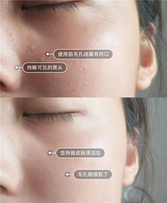 一口气挤出所有陈年黑头，实在是太太太太爽了  毛孔 肌肤 清洁 第11张