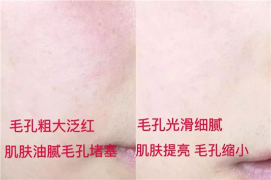 一口气挤出所有陈年黑头，实在是太太太太爽了  毛孔 肌肤 清洁 第32张