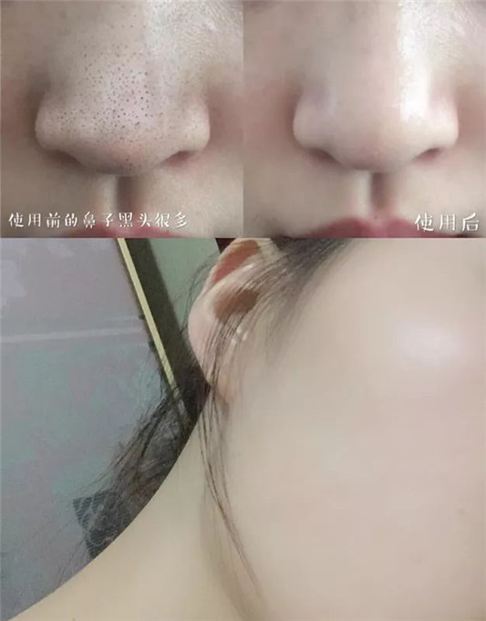 一口气挤出所有陈年黑头，实在是太太太太爽了  毛孔 肌肤 清洁 第33张