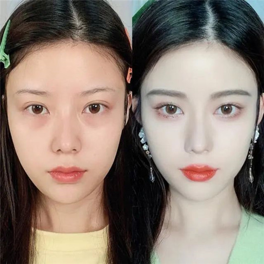 为什么你打玻尿酸，能被人一眼看出来这四个地方要谨慎注射
