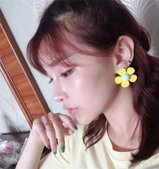 为什么你打玻尿酸，能被人一眼看出来这四个地方要谨慎注射  玻尿酸 尿酸 这四 第2张