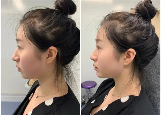 为什么你打玻尿酸，能被人一眼看出来这四个地方要谨慎注射  玻尿酸 尿酸 这四 第3张
