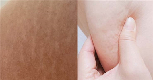 大腿橘皮组织怎么消除，10个消除橘皮组织的方法