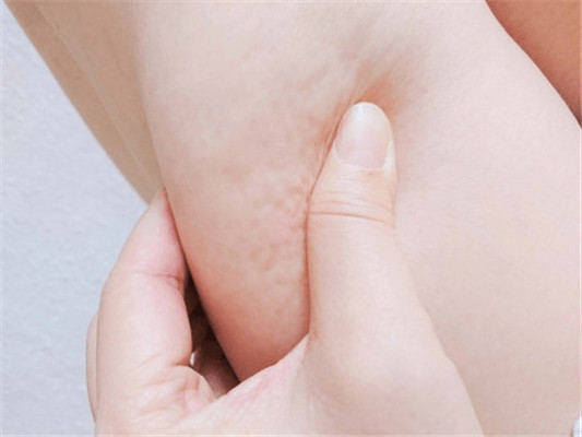 大腿橘皮组织怎么消除,10个消除橘皮组织的方法 橘皮 肥胖纹 第2张 大腿橘皮组织怎么消除,10个消除橘皮组织的方法 橘皮 肥胖纹 第2张