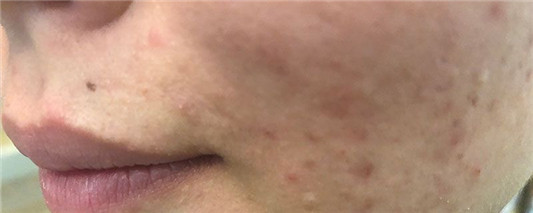 脸上长痘痘可以化妆吗，根据你痘痘的情况决定  痘痘 化妆 情况 第2张