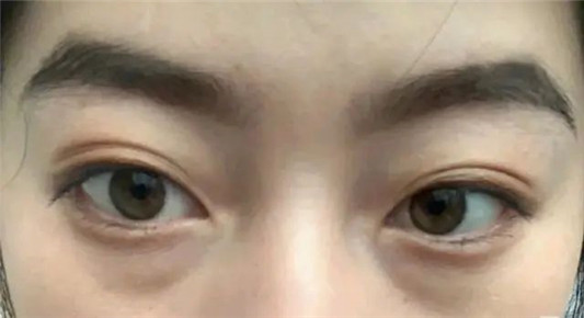 黑眼圈很影响美观，想告别黑眼圈最好用的方法  黑眼圈 好用 最好用 第2张