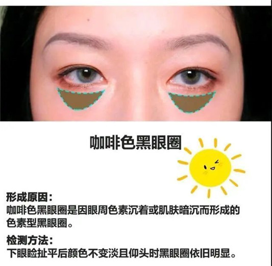 黑眼圈很影响美观，想告别黑眼圈最好用的方法  黑眼圈 好用 最好用 第6张