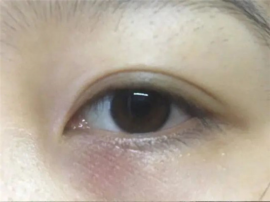 黑眼圈很影响美观，想告别黑眼圈最好用的方法  黑眼圈 好用 最好用 第7张