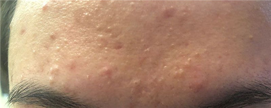 眉毛长痘痘怎么办