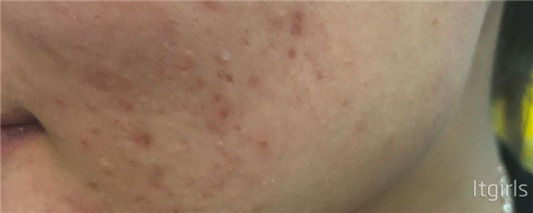 为什么脸上会长痘痘,脸上痘痘和这些不良习惯是分不开的 2020 痘痘 分泌 第2张 为什么脸上会长痘痘,脸上痘痘和这些不良习惯是分不开的 2020 痘痘 分泌 第2张