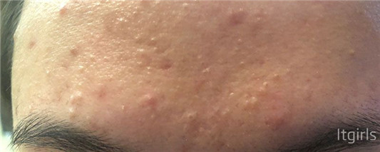 为什么眉毛里老长痘痘，眉毛长痘的原因