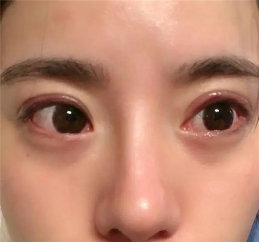建议年轻女生不要纹「美瞳线」，不仅显老还有风险  2020 px 女生 第8张