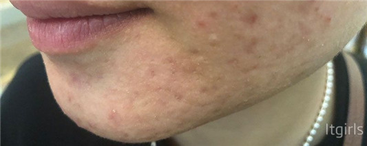 换季长痘怎么办，换季长痘这样做  2020 分泌 痘痘 第2张