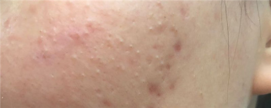 痘痘破了能擦维e吗