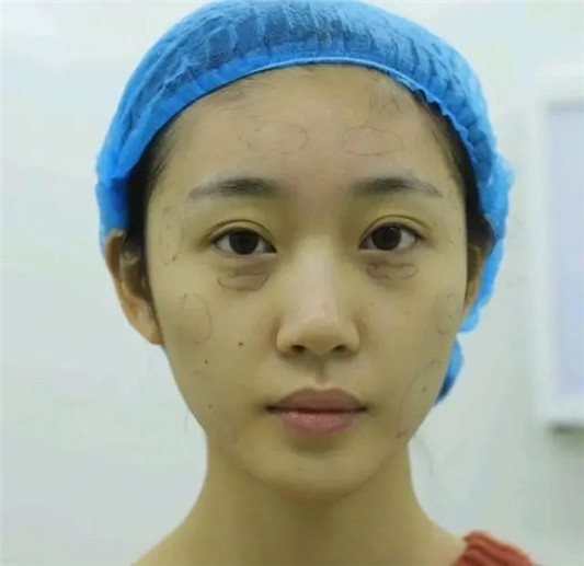 如何一眼辨别整容脸「灯光下变透明 打了玻尿酸也能一清二楚  2020 女生 双眼皮 第7张