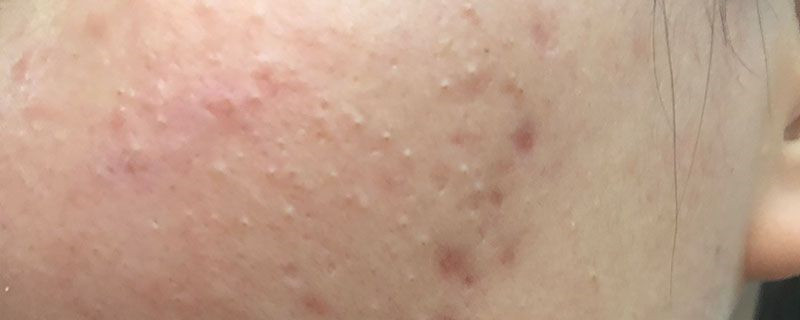 什么可以遮疤痕